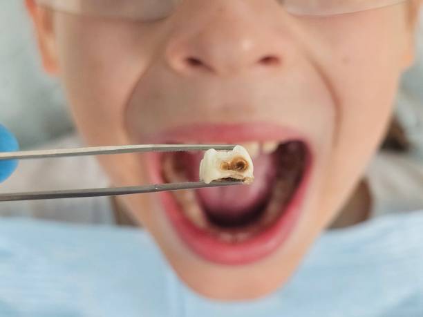 Urgent Tooth Repair in IL
